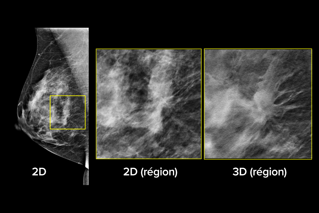 Images cliniques d’une mammographie avec lésion suspecte