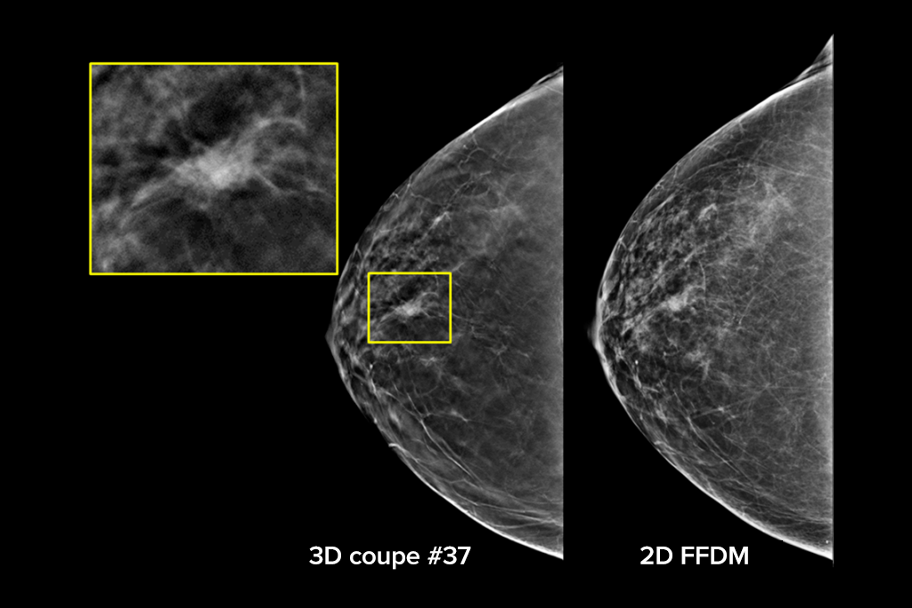 Images cliniques d’une mammographie
