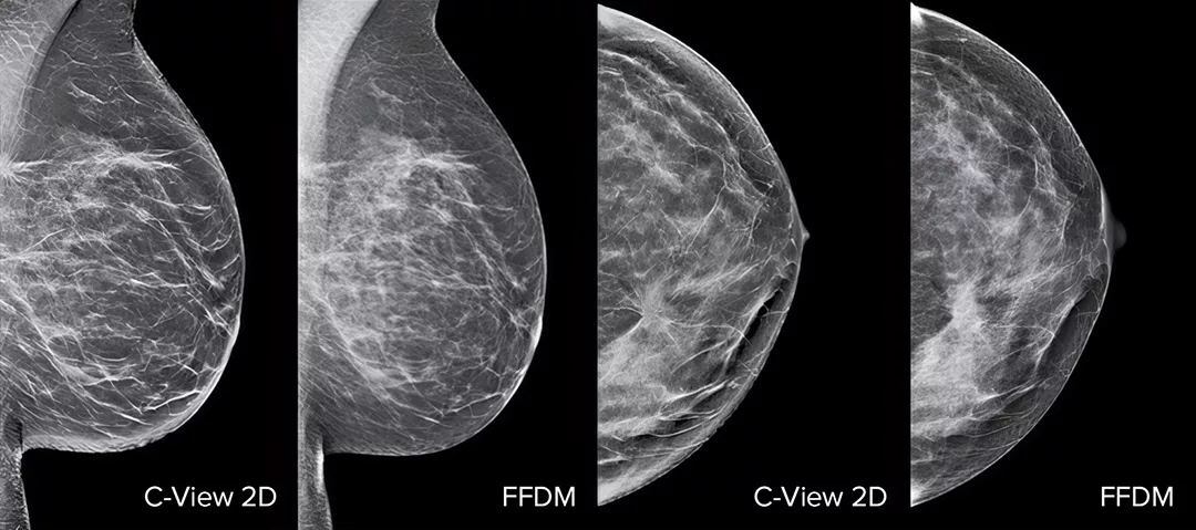 Images d’une radiographie du sein