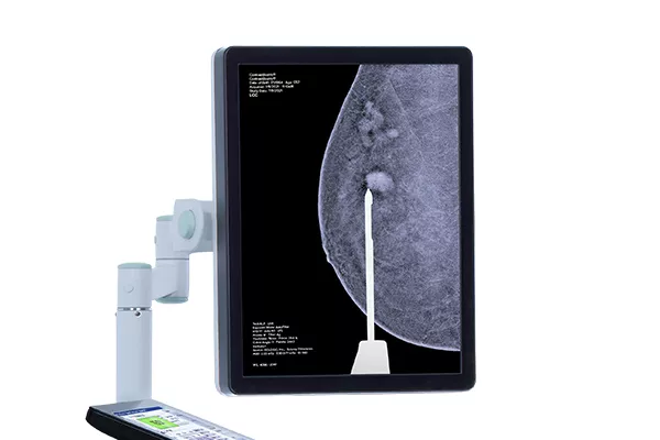 Mammographie de contraste 3D sur un écran d'ordinateur