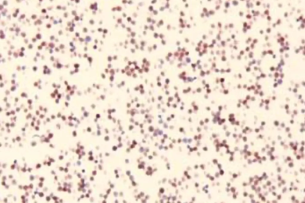 Bloc cellulaire colorant les cellules positives pour le lymphome à cellules T