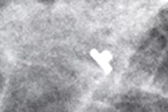 Forme de haut-de-forme sur une mammographie