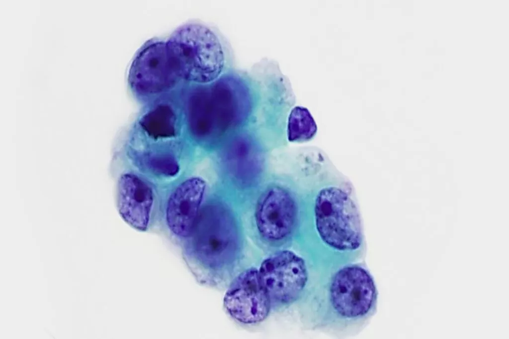 Adénocarcinome, lavage bronchique, coloration Papanicolaou