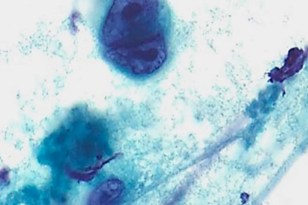 Lymphome de Hodgkins, aspiration à l’aiguille fine dans le cou, coloration Papanicolaou