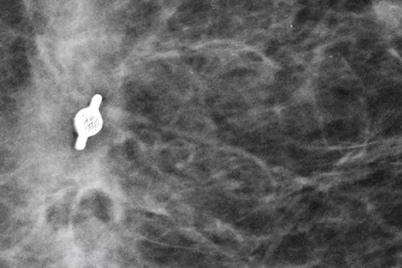 Marqueur de site de biopsie sur une mammographie