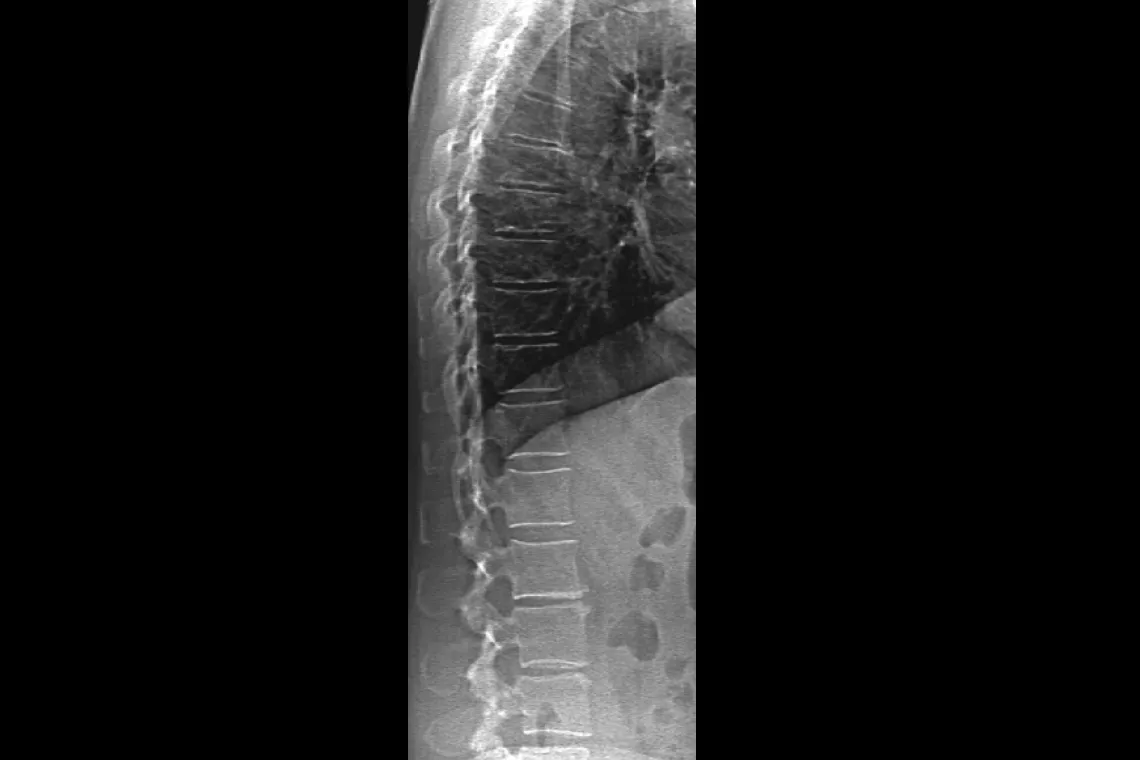 Radiographie du rachis