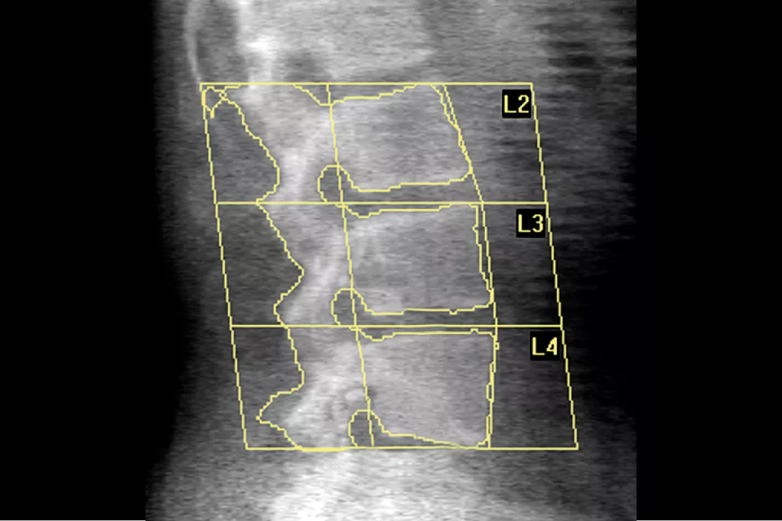 Radiographie du rachis