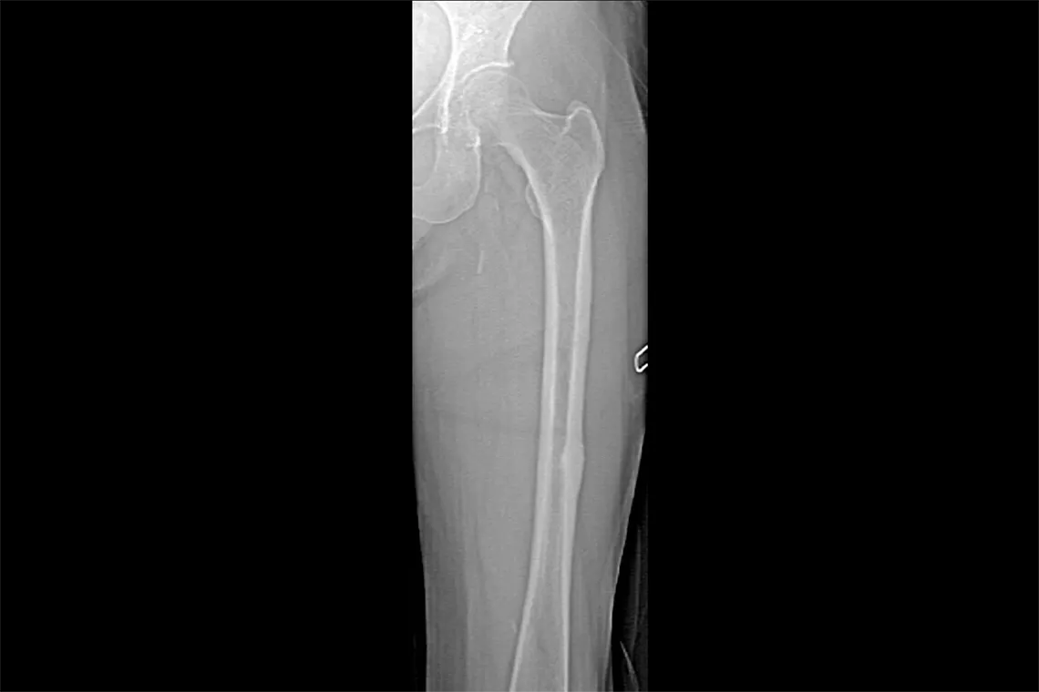 Radiographie d’un os de la jambe
