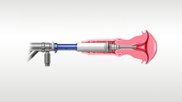 Illustration d’un dispositif médical en cours d’utilisation